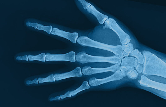 Outcome of a Hand Orthosis and Hand Therapy for Carpometacarpal Osteoarthritis in Daily Practice: A Prospective Cohort Study.